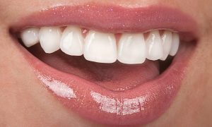 Độ bền của răng sứ được sử dụng bao nhiêu lâu